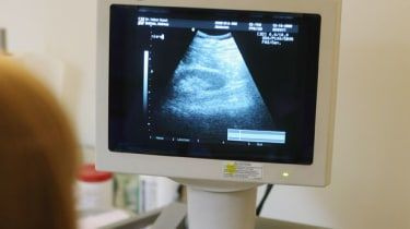 Alabama leder USA:s krig mot abort